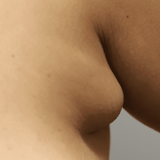 Classic appearance of axillary breast tissue.