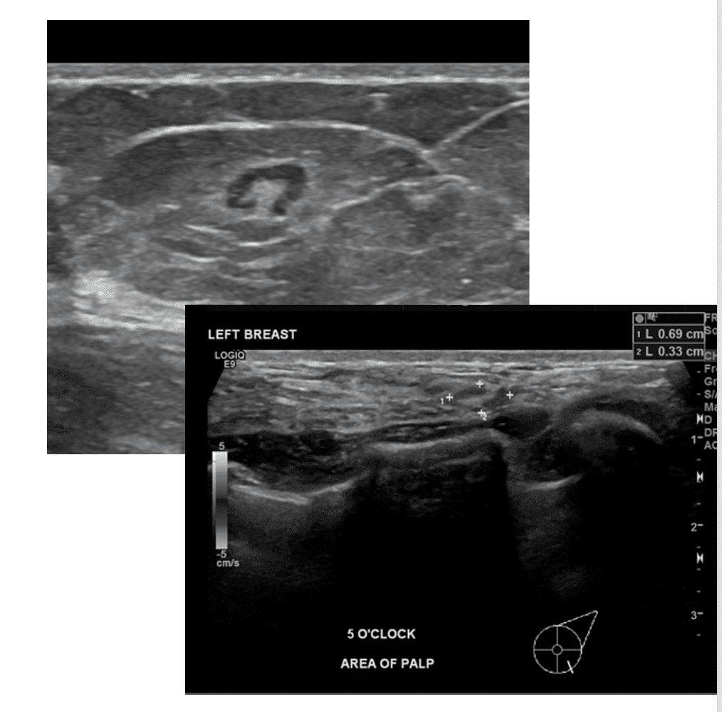 Intramammary lymph nodes with normal fatty hilum (central aspect) and size (bean shaped structure on upper image and outlined with crosses on lower image). The fatty hilium is lost when a lymph node is involved with cancer.