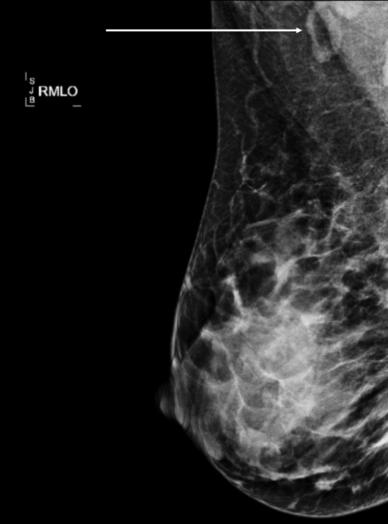 Normal lymph node under arm (axilla) visualized on mammogram.