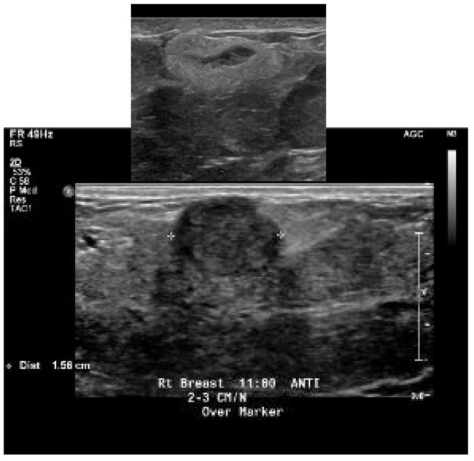 Ultrasound appearance of fat necrosis.