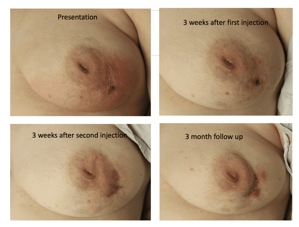 Presentation of initial IGM and post treatment