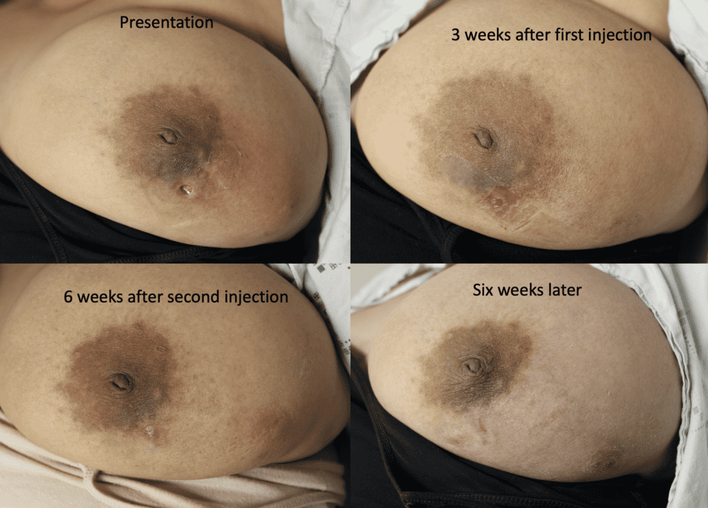 Presentation of initial IGM and post treatment