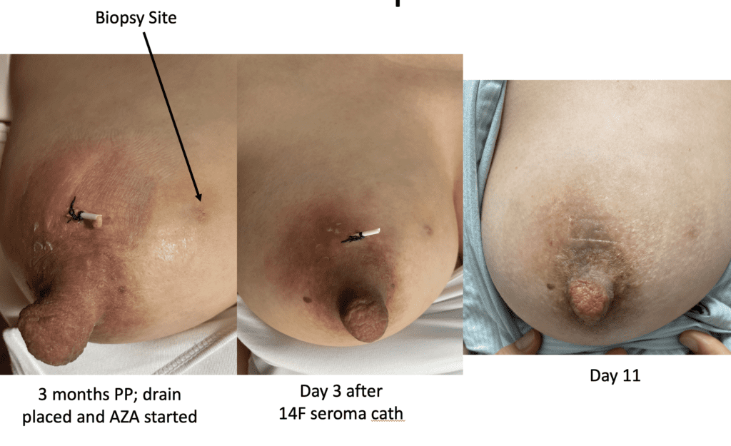 Breastfeeding patient who resolved IGM symptoms within two weeks of starting azathioprine and continued breastfeeding from the affected breast without issue.