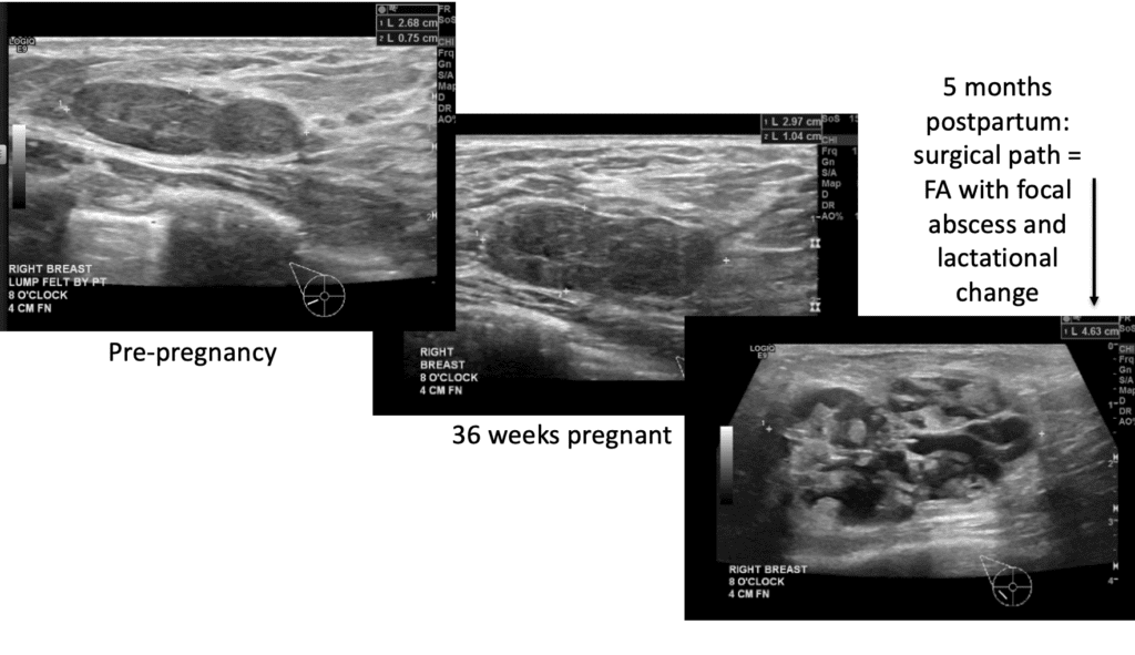 Breast image 5 months postpartum: surgical path = FA with focal abscess and lactational change