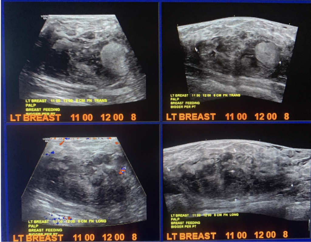 Fibroadenoma that developed complex appearance during lactation and was excised.