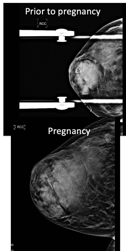 Breast images of hamartoma prior to pregnancy and during pregnancy.