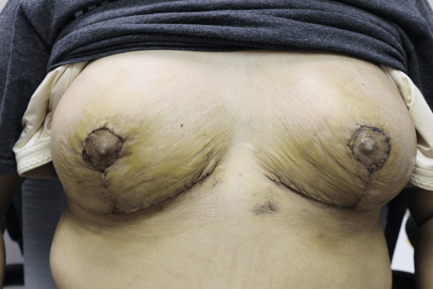 Post surgery breast scars