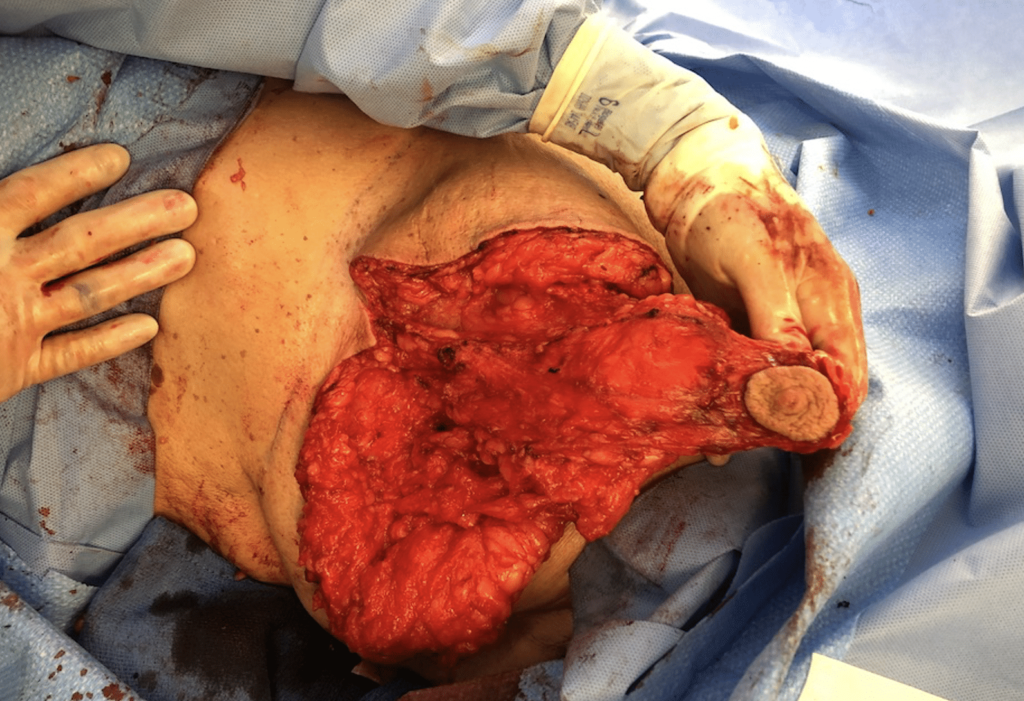 Intraoperative photo showing the column of breast tissue, blood vessels, and nerves that remain connected to the nipple and areola.