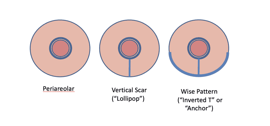 These are the most common incision closures for breast reductions, with the Wise Pattern being most utilized today. The incision alone does not reflect what type of removal of tissue was performed in the breast.