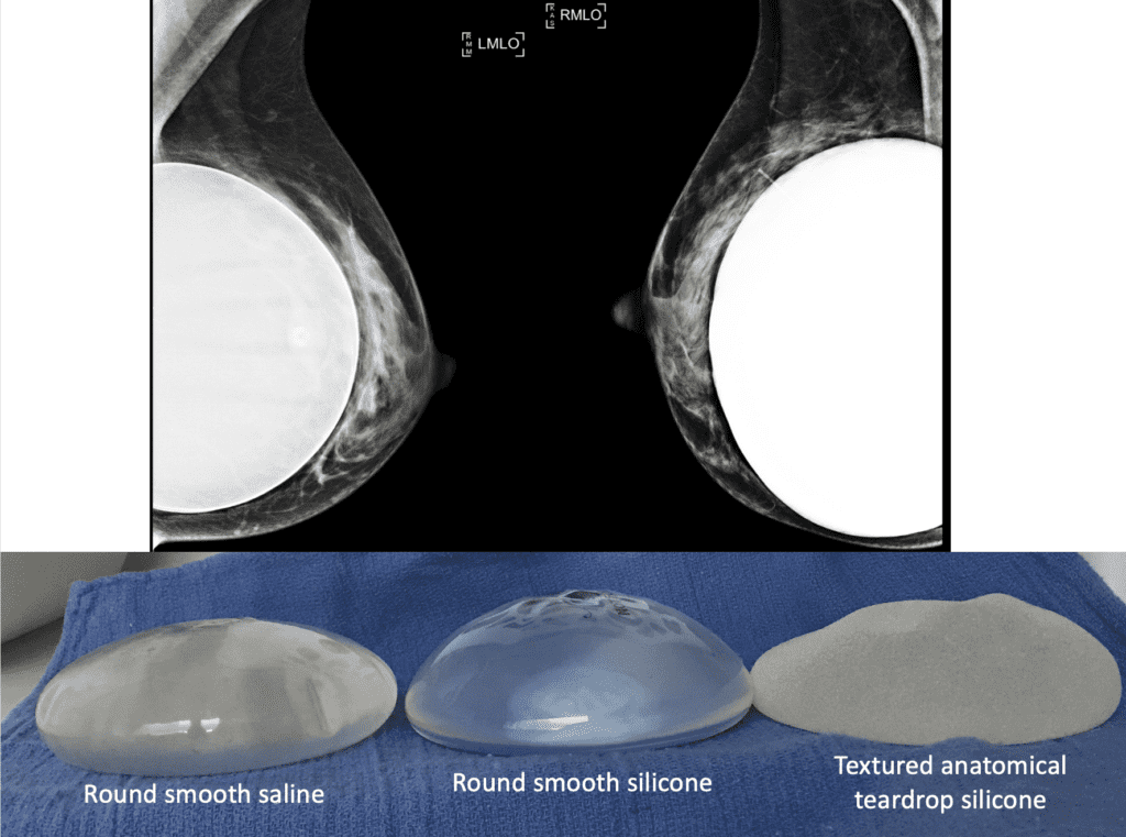 Image of breasts with implant options