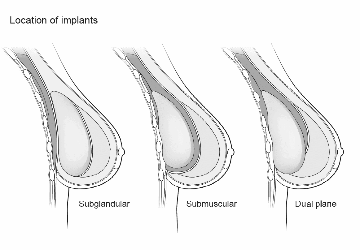 Location of breast implants