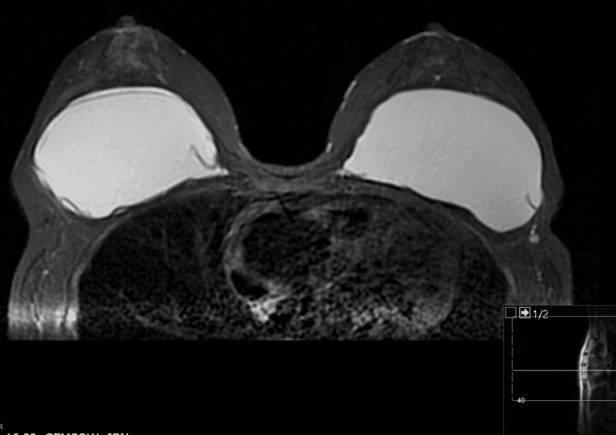 Rupture of silicone implant visualized on MRI.