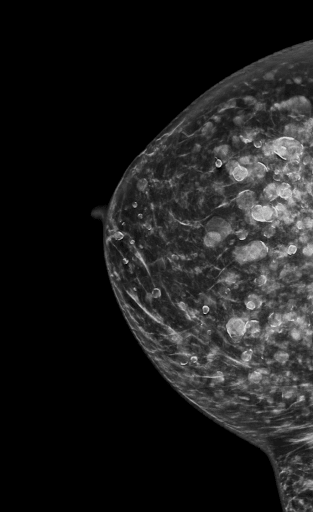 Silicone injection appearance on mammogram. This patient breastfed without issue.