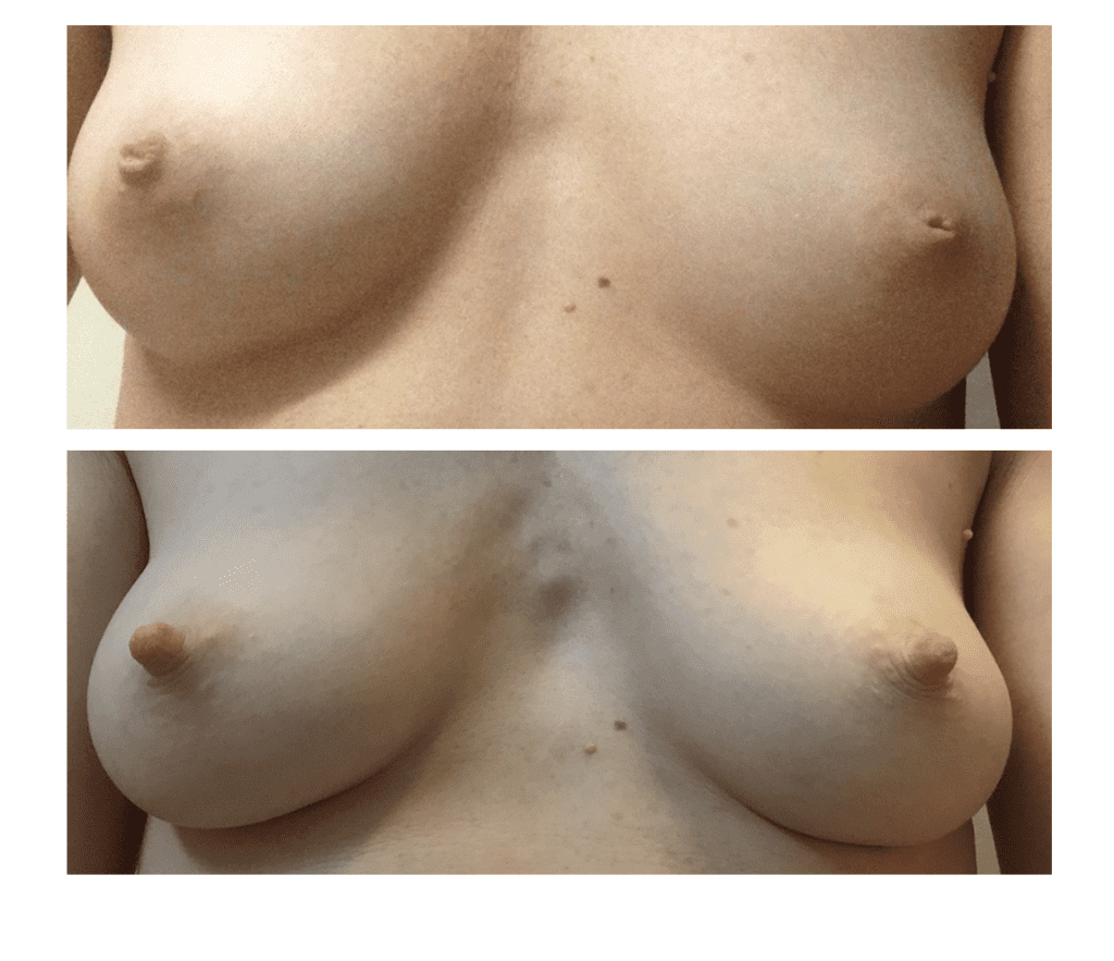 Patient with more mild inversion during pregnancy and one year postpartum. As you see, her nipples everted completely with breastfeeding and pumping while at work.