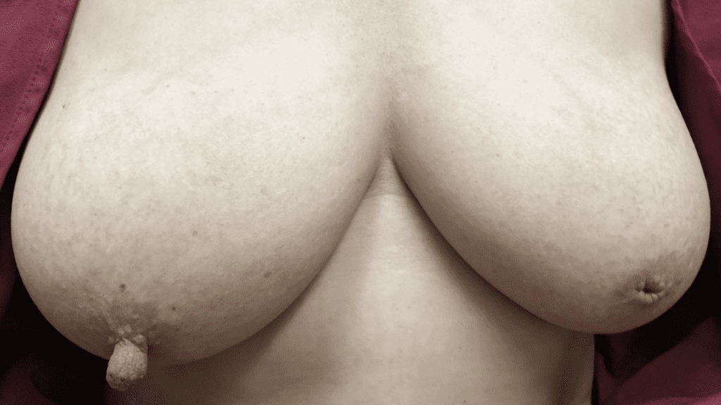 This patient breastfed two children both over two years from her right breast only.