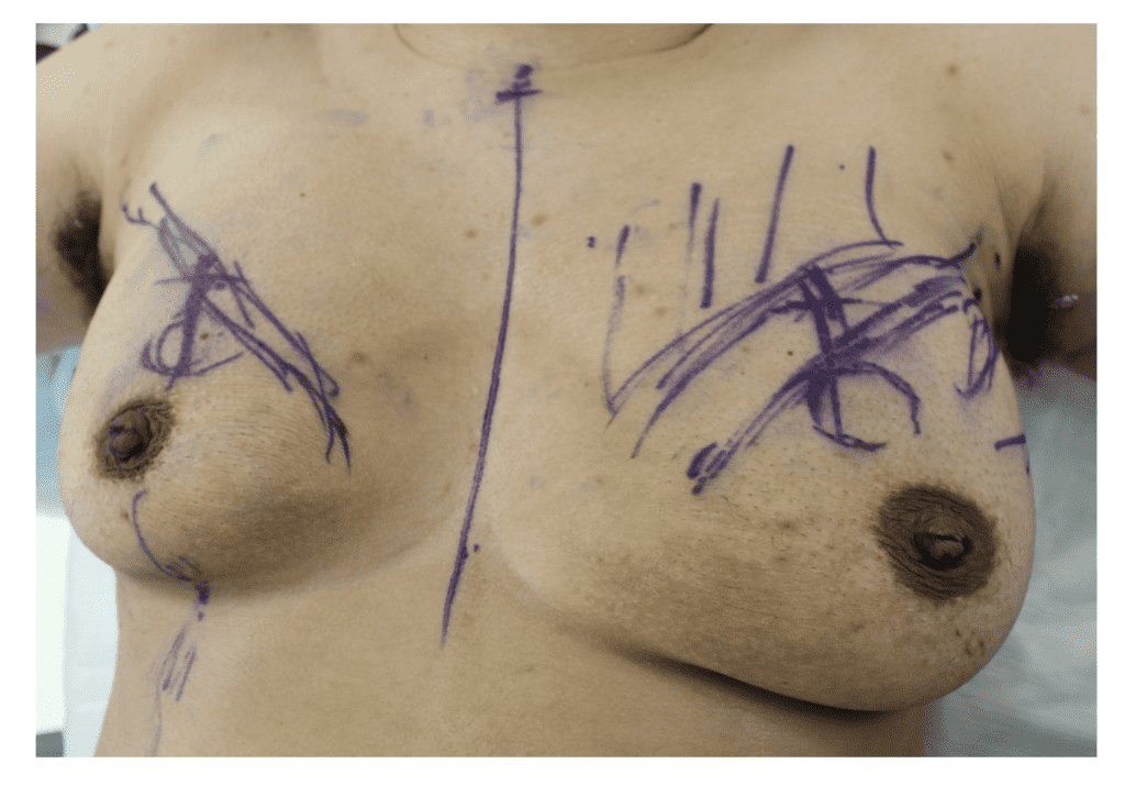 Doctor markings pre gender affirmation surgery