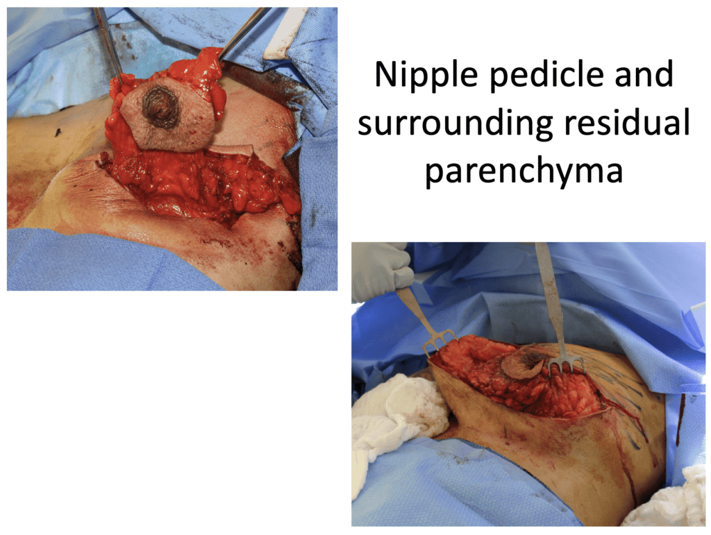 Nipple pedicle and surrounding residual parenchyma