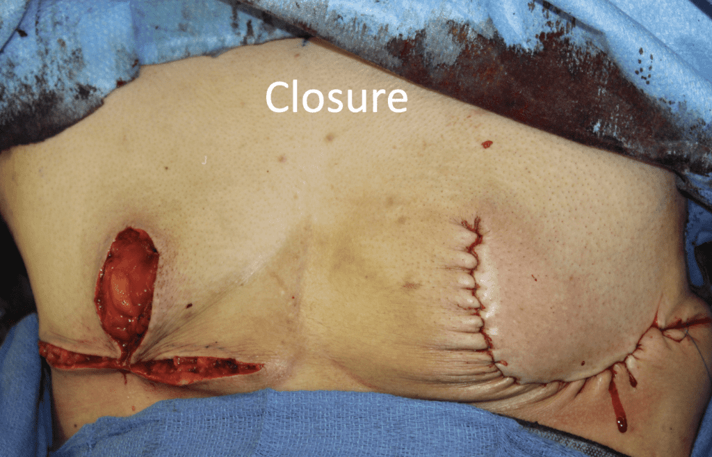 Gender affirming surgery closure