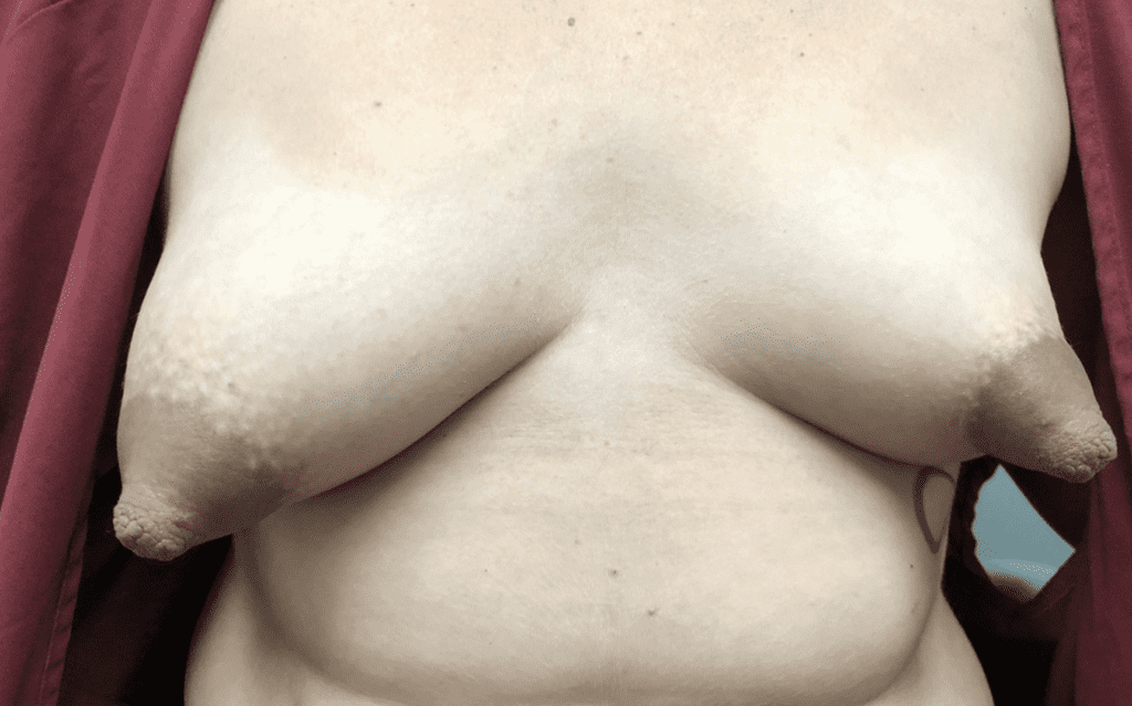 Significant tubular breast. Baby latched well to breast but lost significant weight after discharge from hospital. Physicians and lactation consultants should watch milk production and weight gain very carefully in these patients as significant tubular breast is not expected to produce substantial milk.