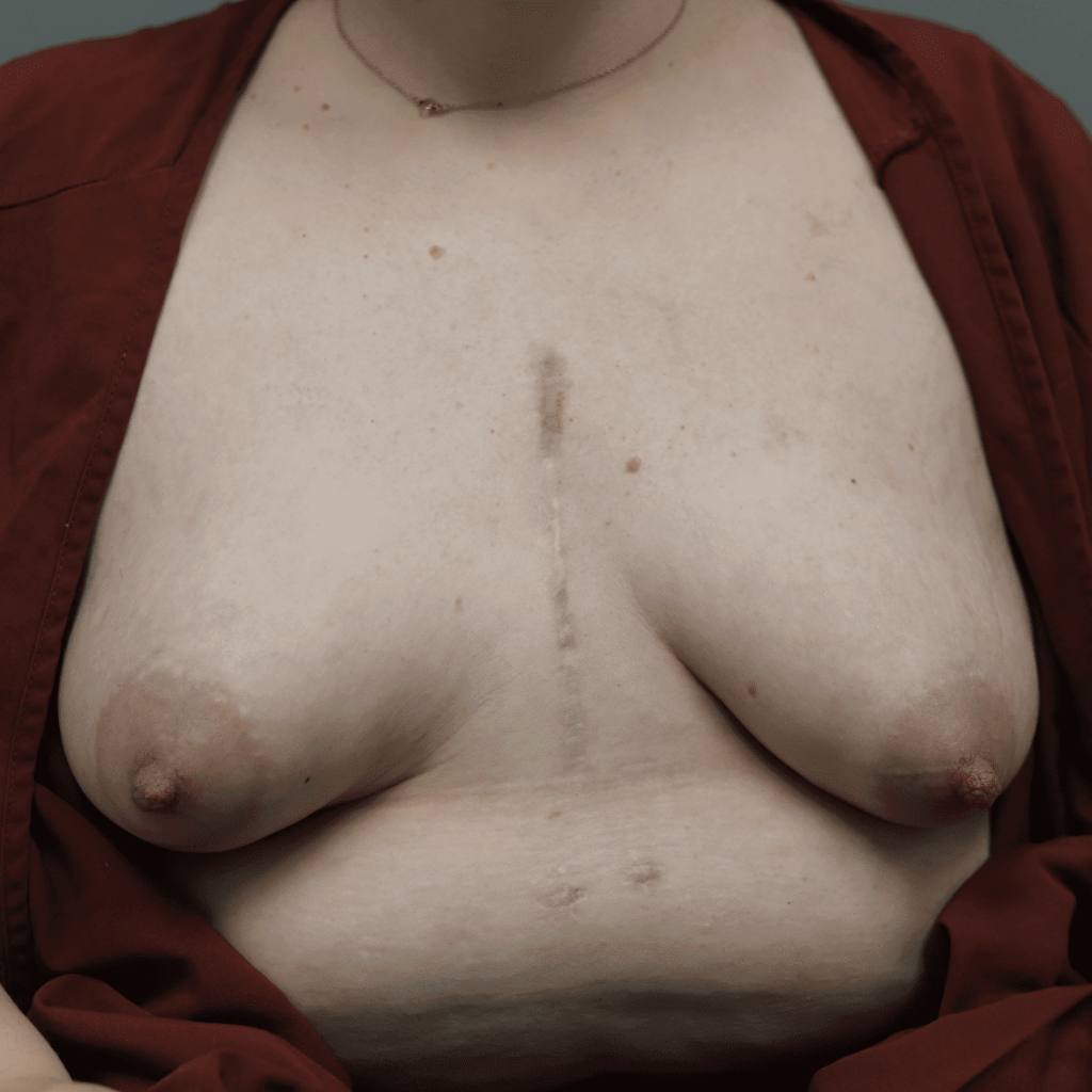 Patient with history of heart surgery as well as moderate tubular appearance of breasts.