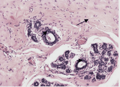 Appearance of tubular breast under microscopic with replacement of normal glands by fibrous tissue (arrow).