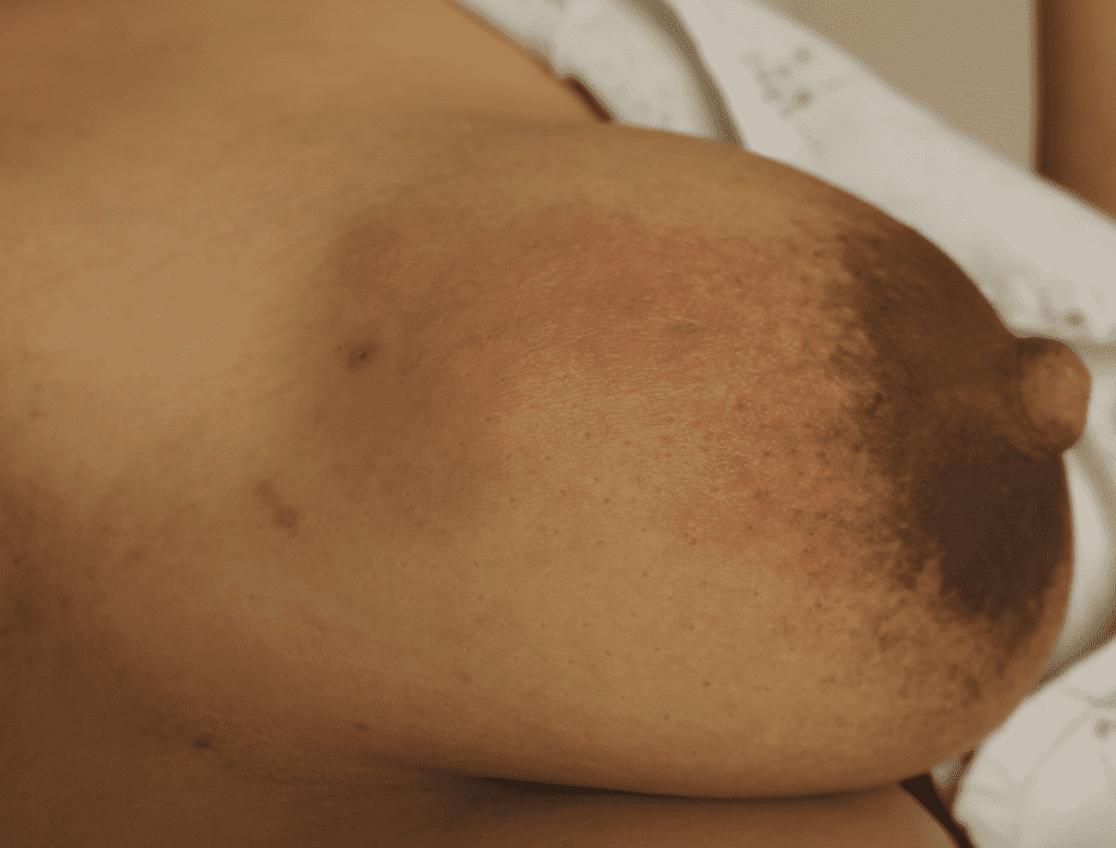 Phlegmon development