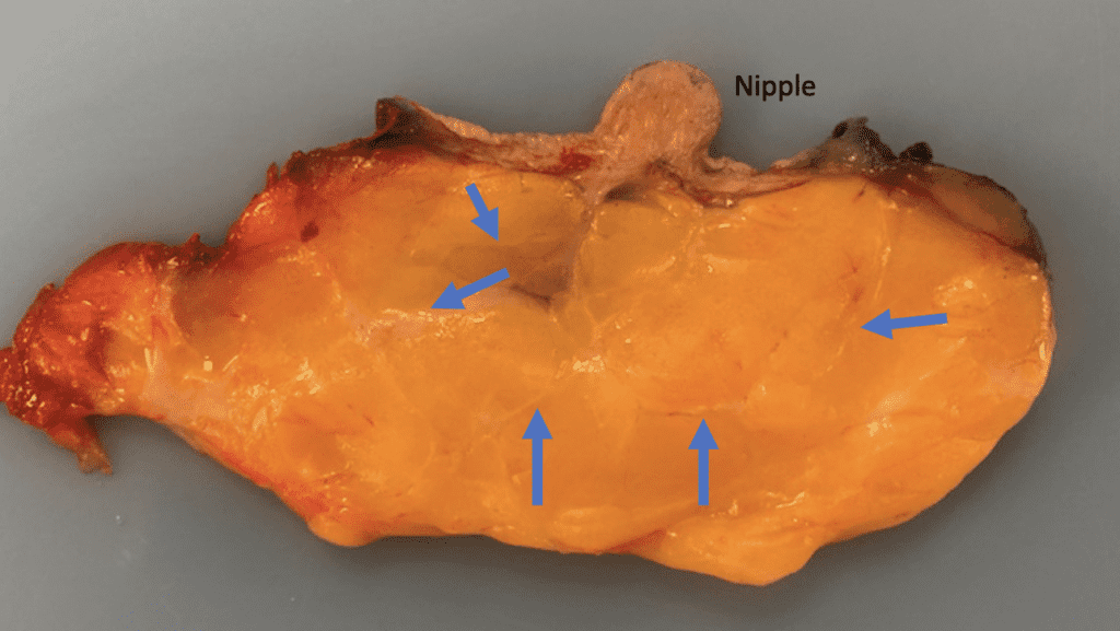Ducts are microscopic, and even the biggest ones are still hard to see with the naked eye (blue arrows). If you massage a breast, you causes swelling around the ducts and worsen tissue inflammation.