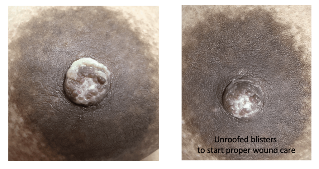Patient with suction blisters from pump that were soaked in epsom salt and became more painful. Blisters were unroofed to allow appropriate wound healing to begin.