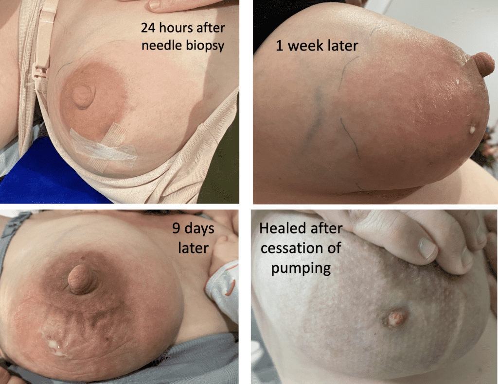 Consequence of being told to “pump to empty” after a needle biopsy. The patient resolved her symptoms and the fistula site closed after she stopped pumping and resolved her hyperlactation (oversupply).