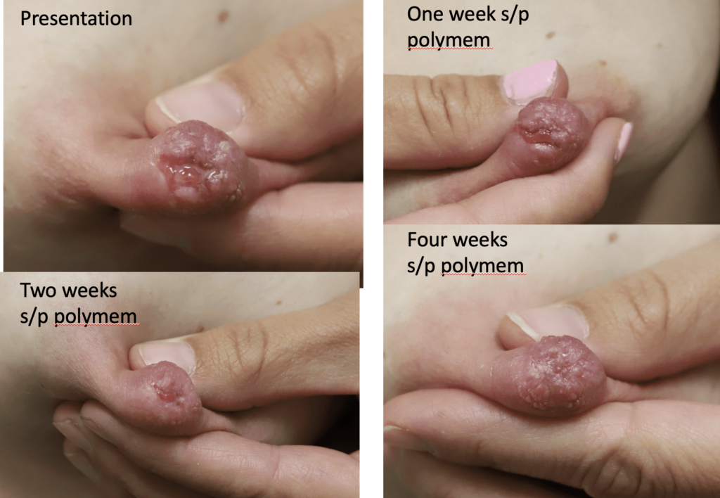 Progression from open wound in nipple to 4 weeks after being treated with polymem