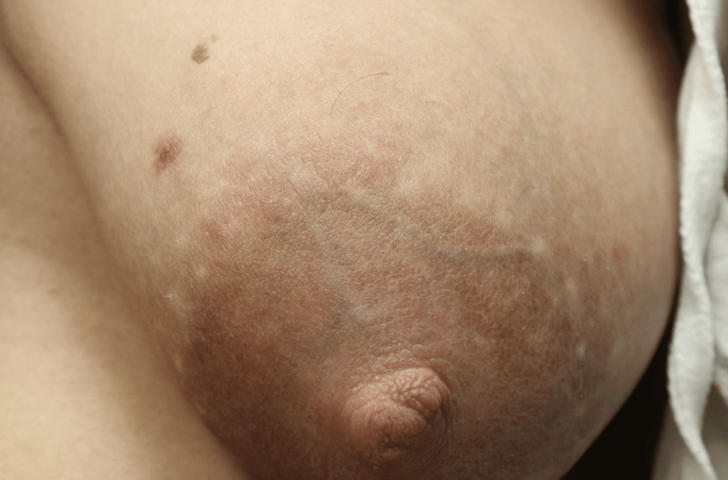 More subtle dermatitis presenting with itching and flaking at areola border at 10-11:00 position.