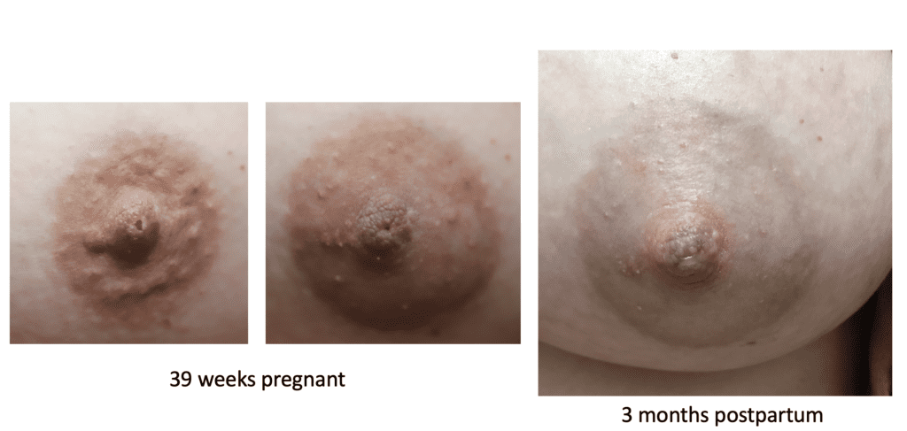 Nipples at 39 weeks and 3 months