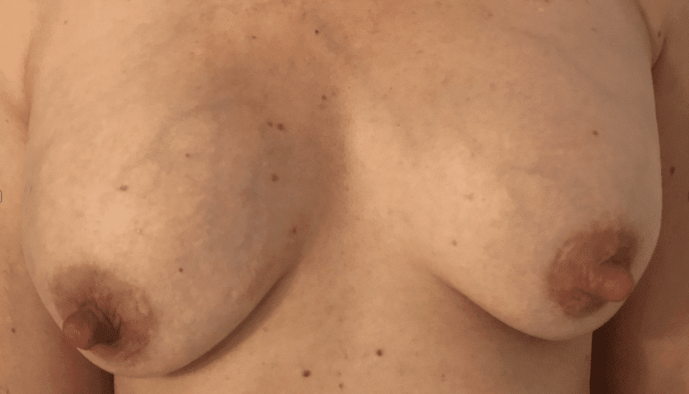 Example of capsular contracture in right breast implant compared to more mild contracture on left. Capsular contracture is scar tissue formation around an implant that makes the implant more firm and immobile. The implants are sitting higher in this patient’s chest wall and her native breast tissue is below. Periareolar incisions on the upper inner parts of her areola.