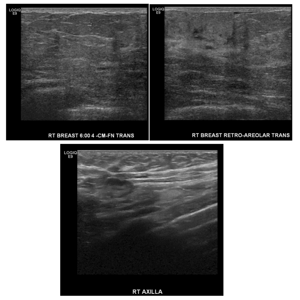 Ultrasound screening during lactation in BRCA I patient