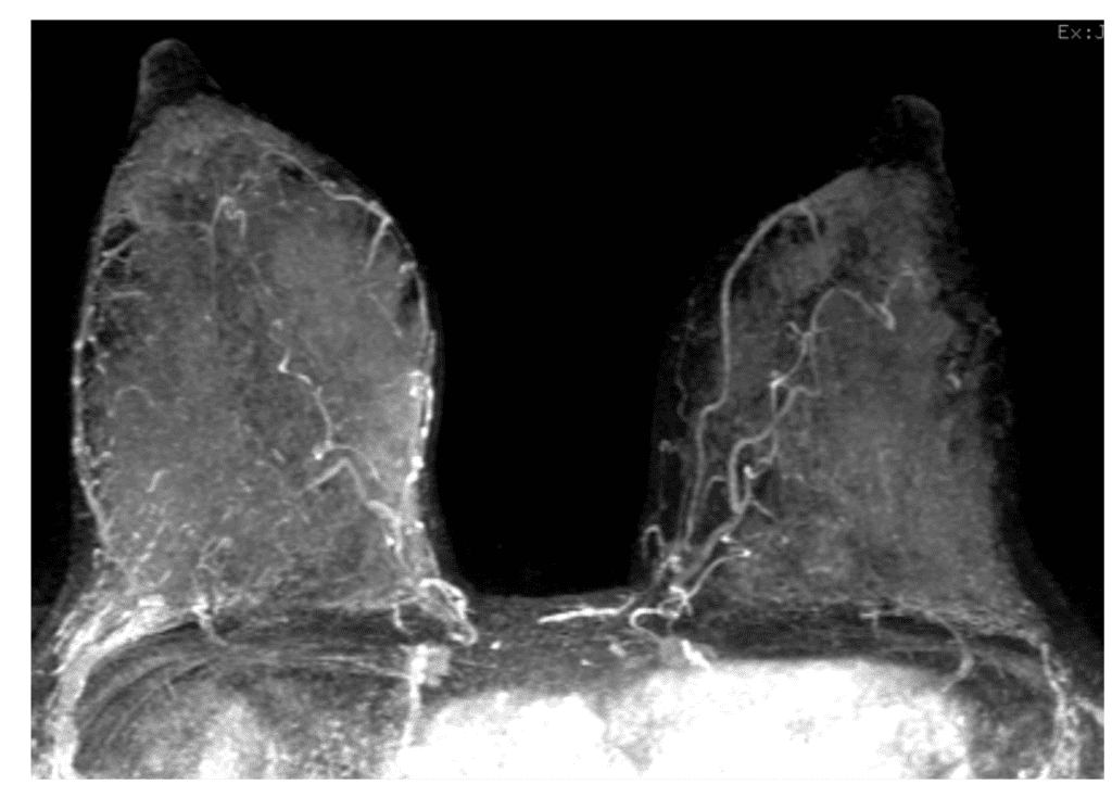 MRI screening during lactation in BRCA I patient