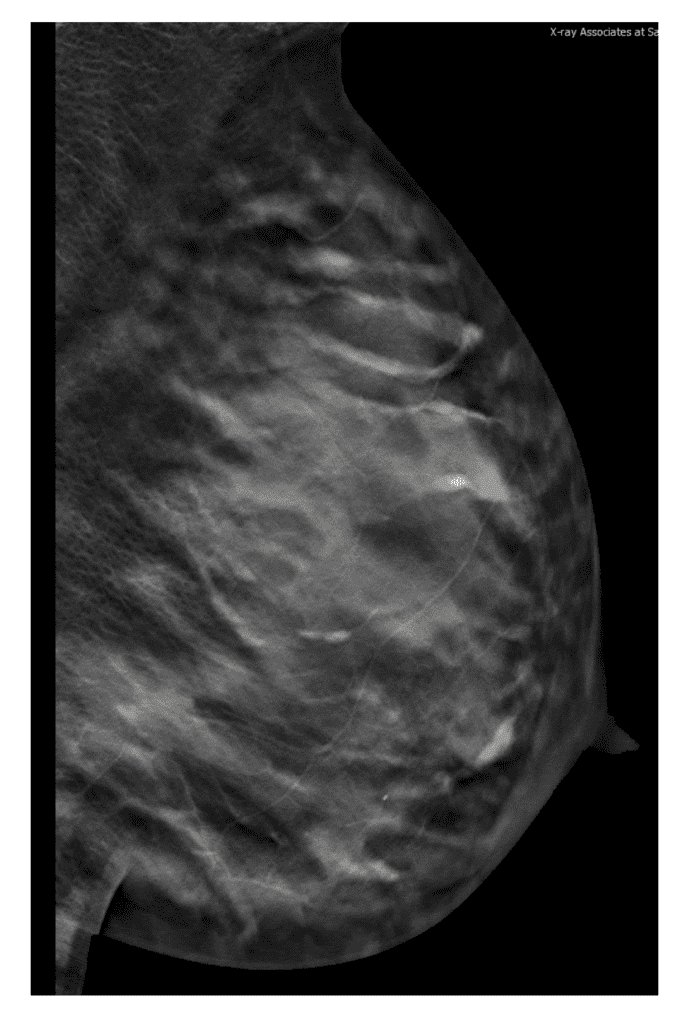 Tomosynthesis (3D) mammogram during lactation in BRCA I patient. 