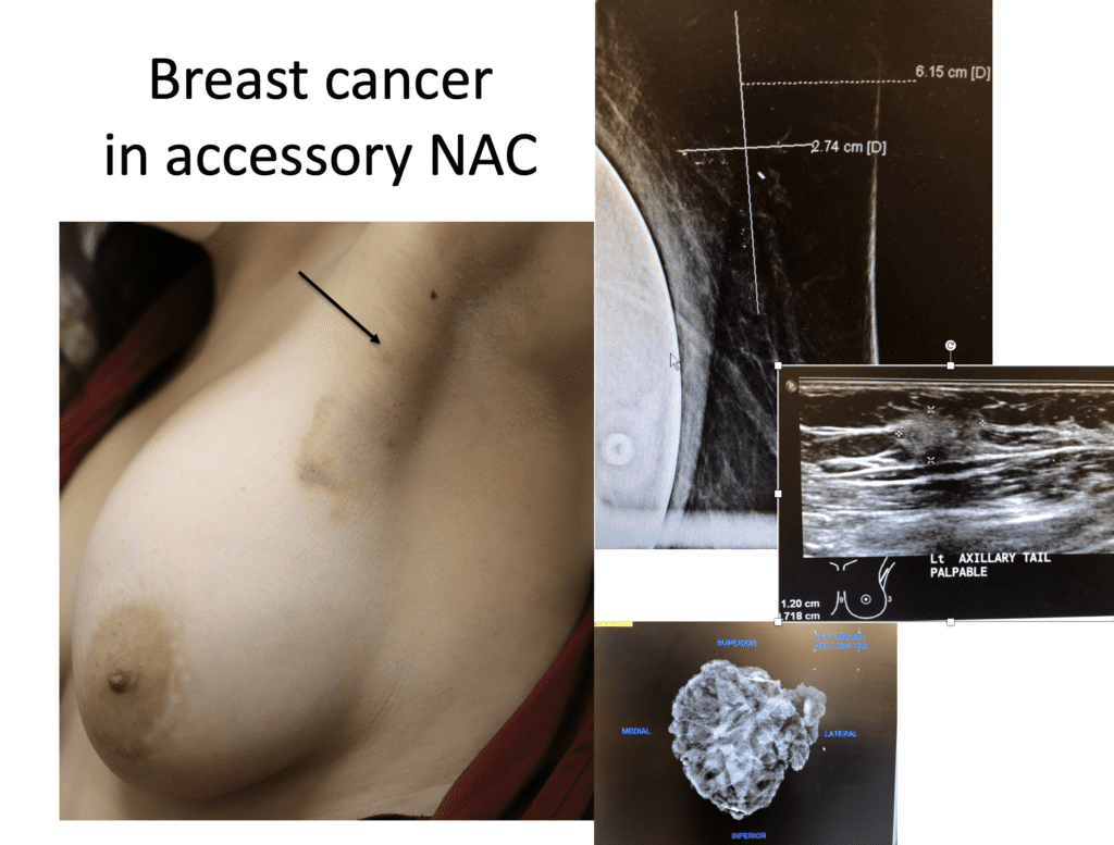 Breast cancer in accessory NAC