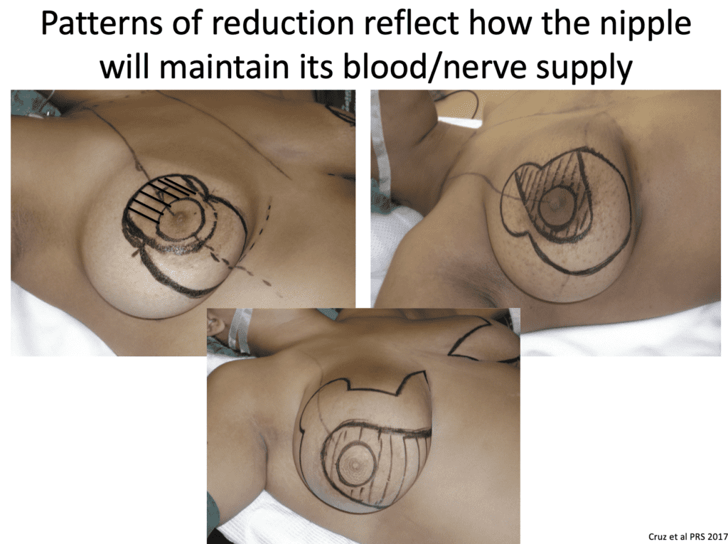 Patterns of reduction reflect how the nipple will maintain its blood/nerve supply