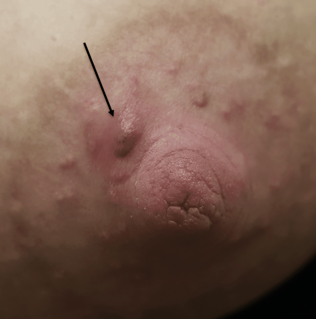 Arrow indicates obstructed Montgomery Gland from coconut oil