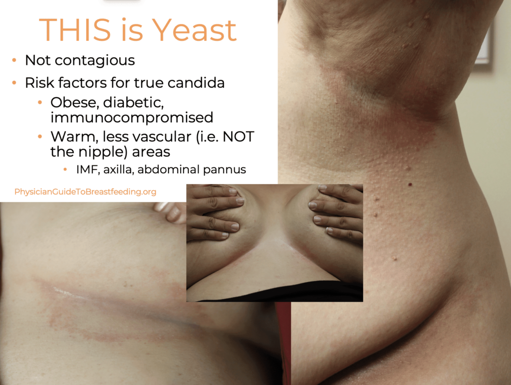 Photo of Yeast on body