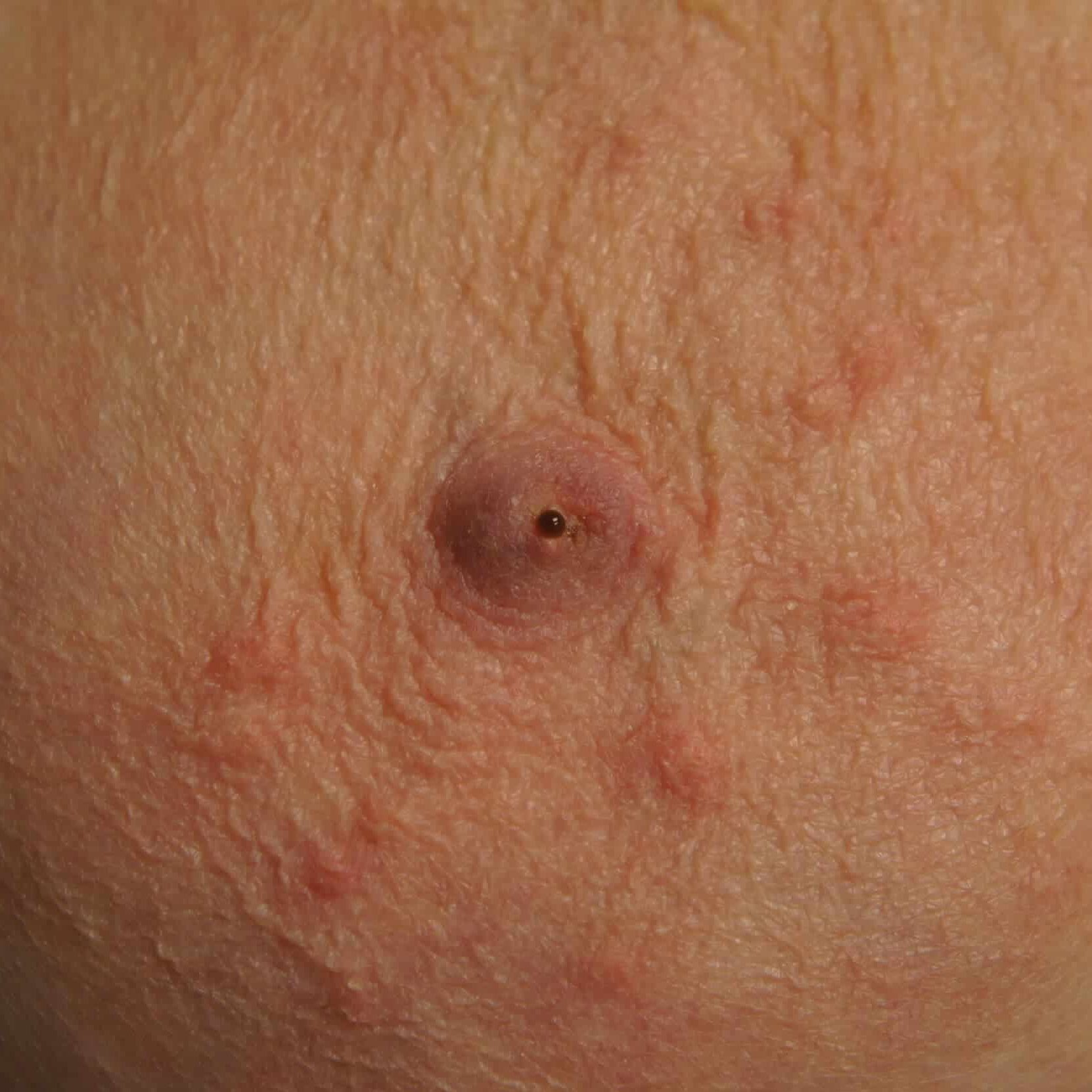 Abnormal discharge occurs without stimulation from a single orifice on one breast.