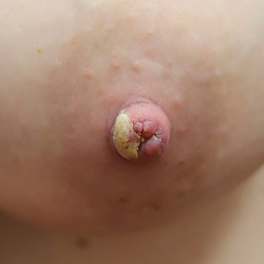 Exclusive pumping nipple crust, asymptomatic