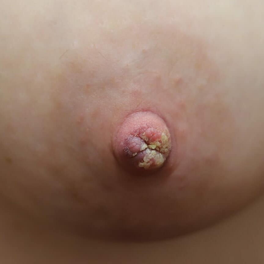 Exclusive pumping nipple crust, asymptomatic
