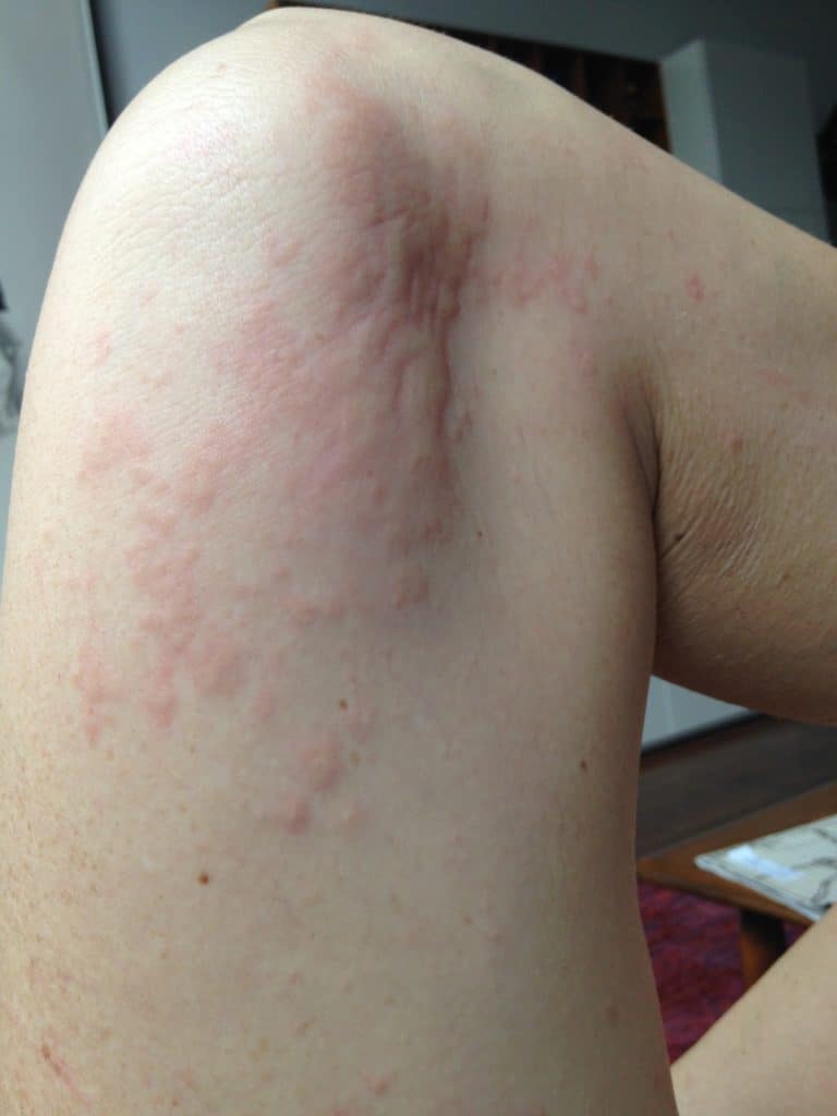 Hives on leg