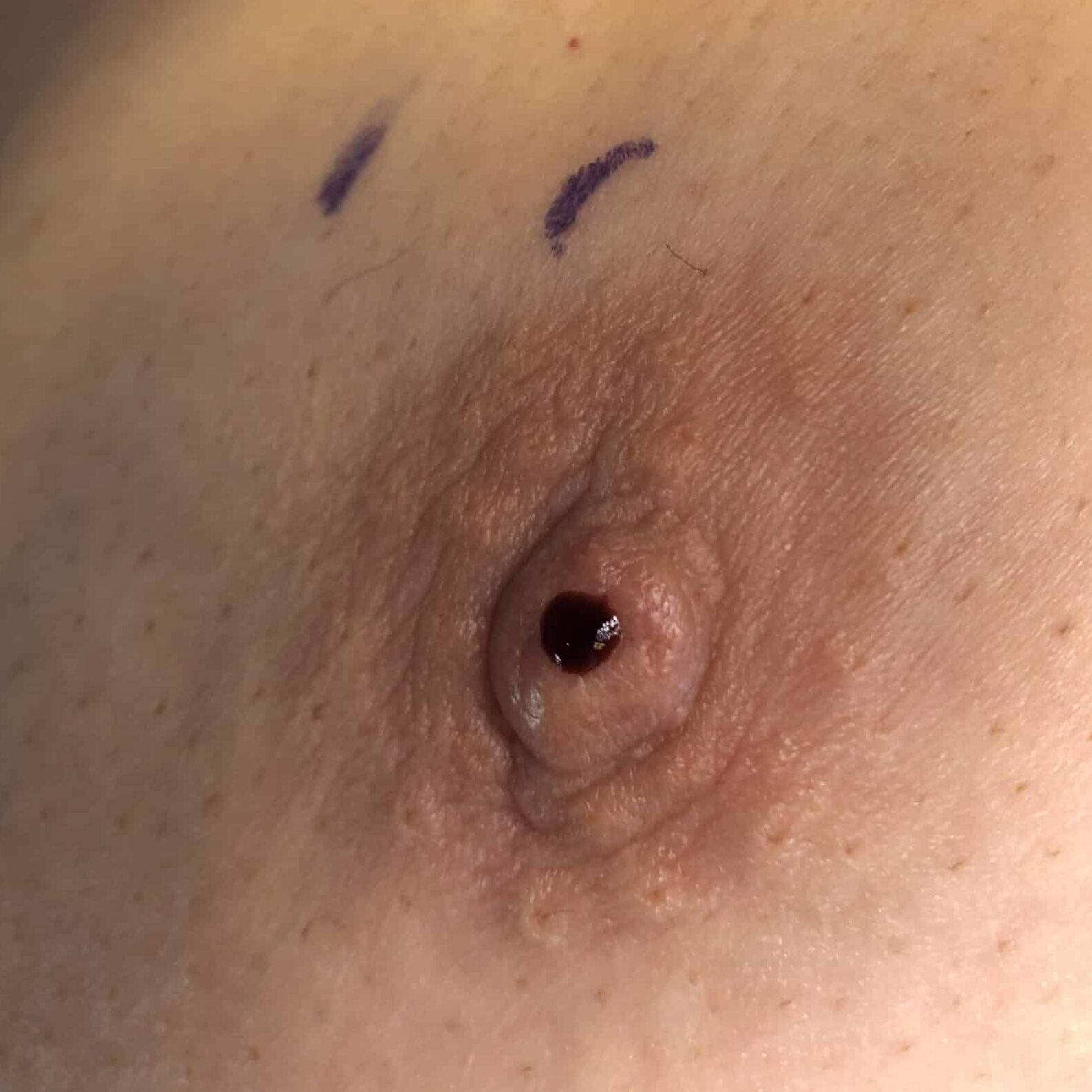 Pathologic bloody discharge