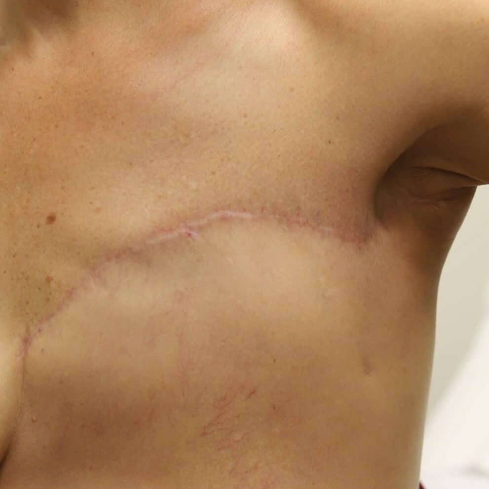 The patient underwent chemotherapy and immunotherapy, removal of lymph nodes, resection of involved skin, and radiation.