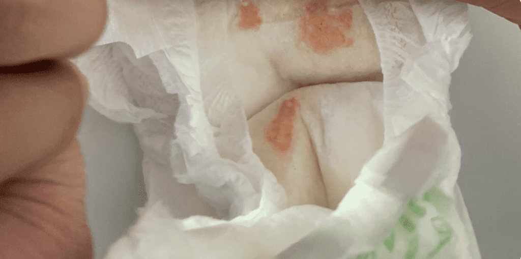 Urate crystals in diaper