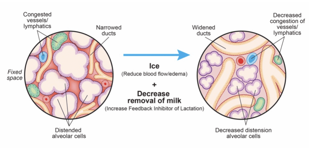 Treatment of breastmilk "plug"