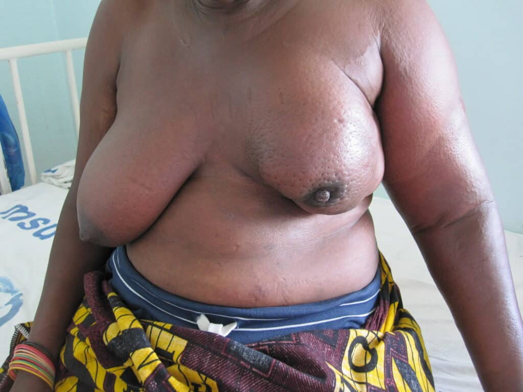 Inflammatory breast cancer with left arm lymphedema