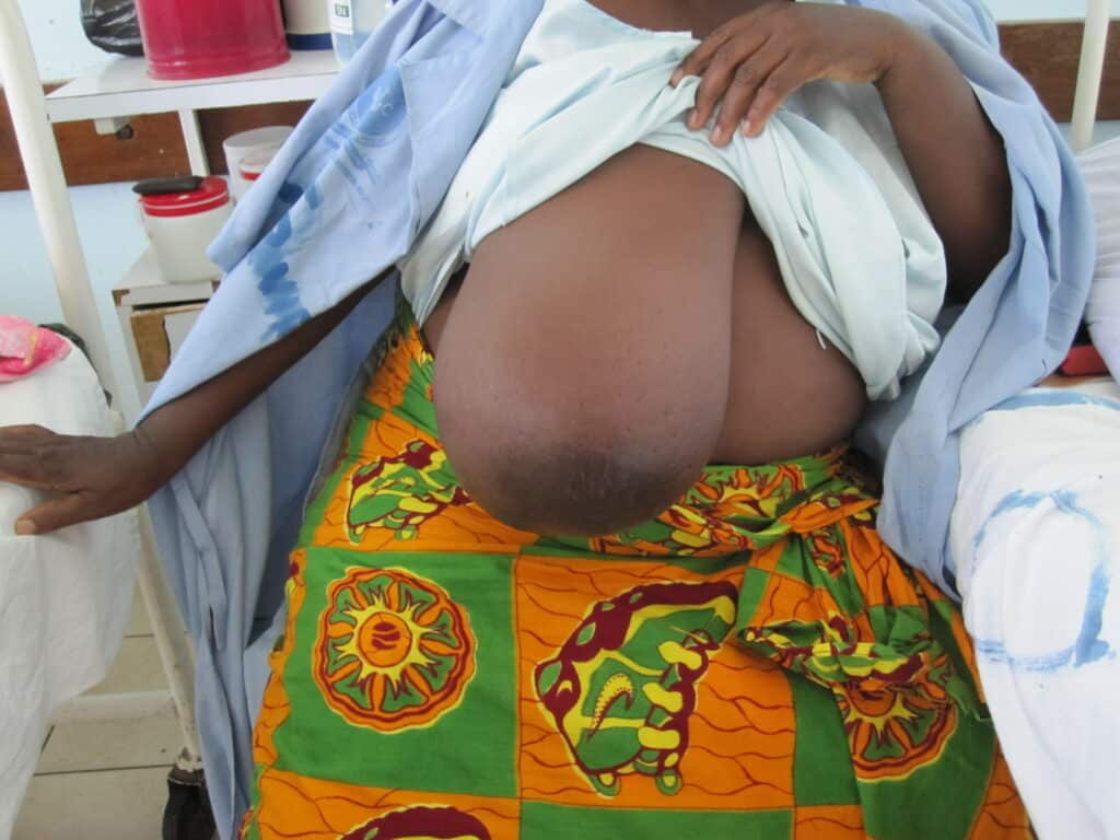 Large phyllodes tumor distorting the right breast